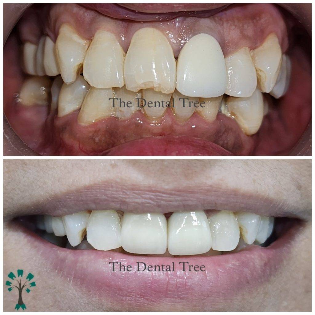 treatment-before-after (4)